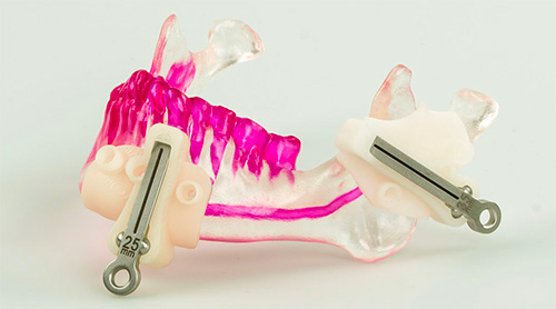 3D-печатная нижняя челюсть